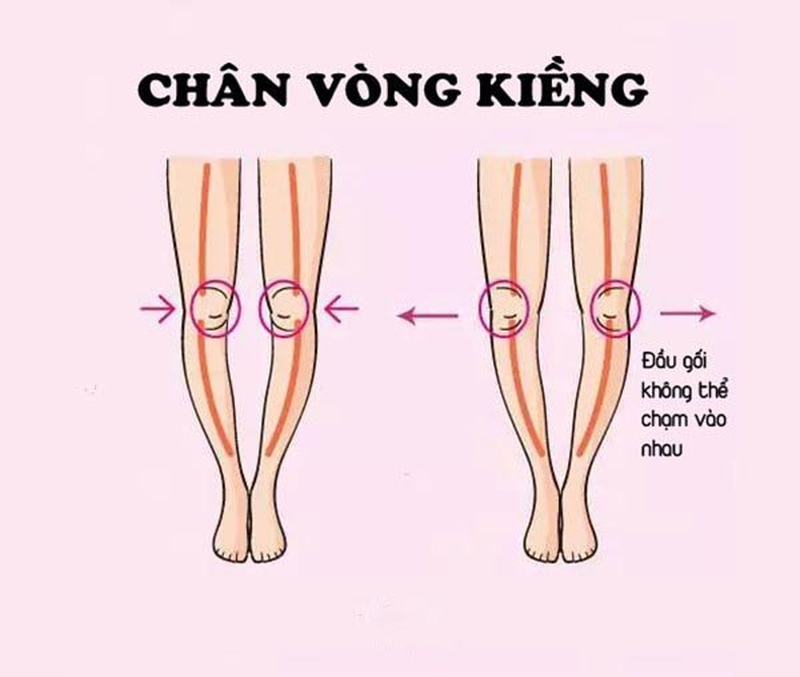 5 bài tập chữa chân vòng kiềng — đúng kỹ thuật, đúng thứ tự, đúng thời điểm