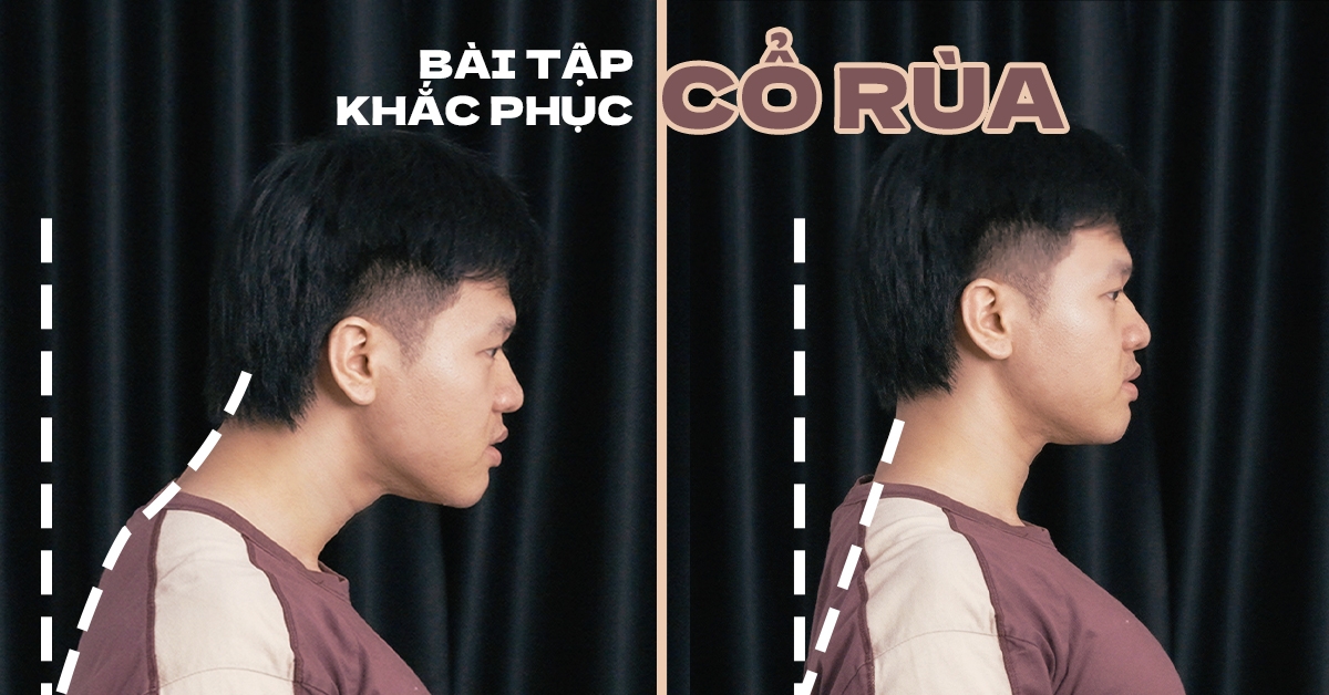 Vì sao bài tập cổ rùa lại quan trọng đến thế — ngay cả khi bạn không đau?