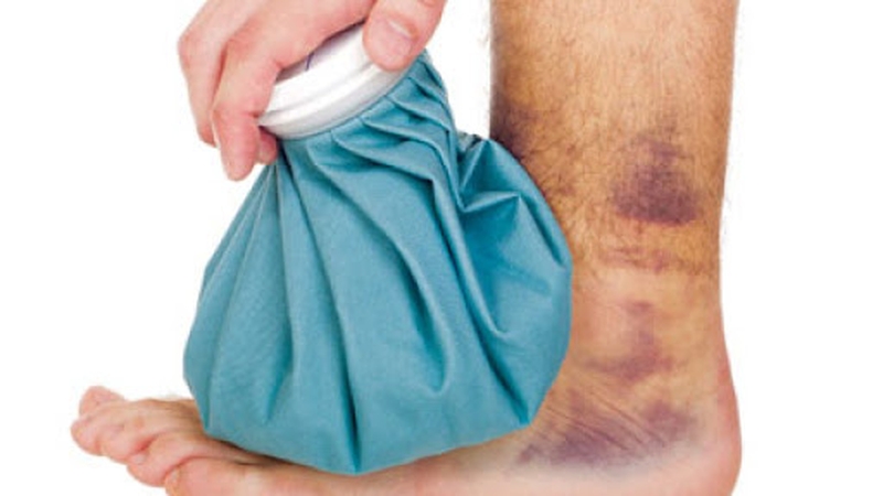 Cách sơ cứu bong gân cổ chân: 4 bước vàng trong 72 giờ đầu