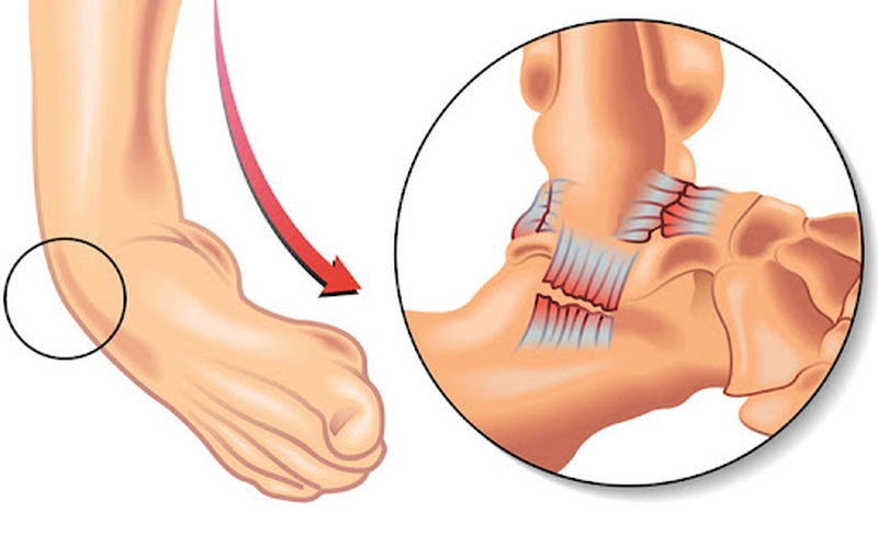Phân mức độ bong gân: từ nhẹ đến nghiêm trọng — bạn đang ở đâu?